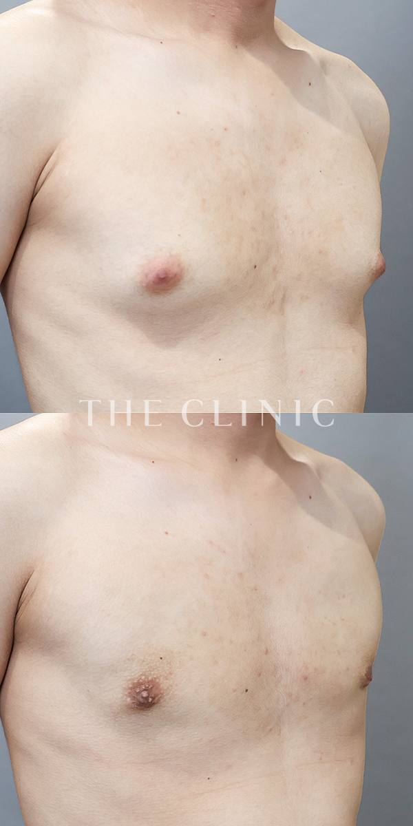 真性＋偽性女性化乳房の女性化乳房治療(男性の胸の膨らみ改善)（21歳男性）の術前・術後写真