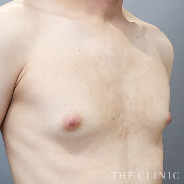 真性＋偽性女性化乳房の女性化乳房治療(男性の胸の膨らみ改善)（21歳男性）の術前写真