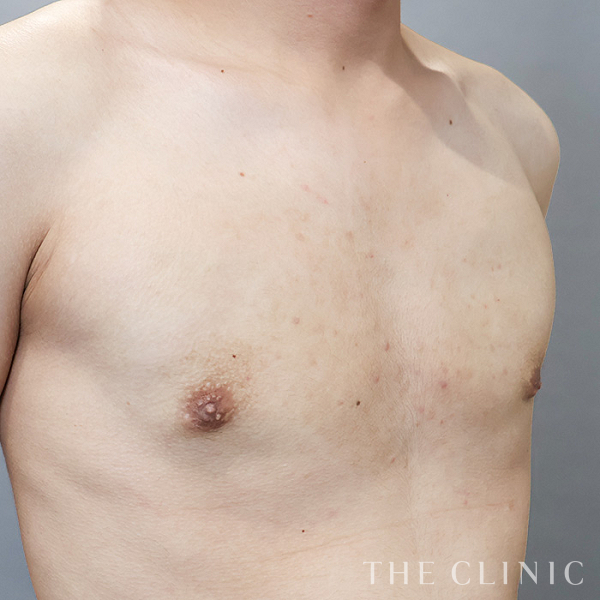 真性＋偽性女性化乳房の女性化乳房治療(男性の胸の膨らみ改善)（21歳男性）の術後写真