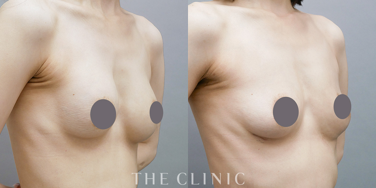 不自然な形の豊胸シリコンバッグ除去（42歳女性）の術前／術後