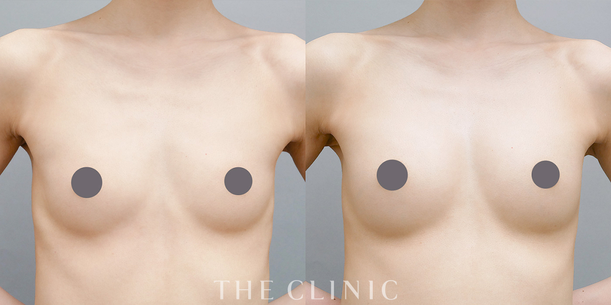 コンデンスリッチ豊胸の術前／術後