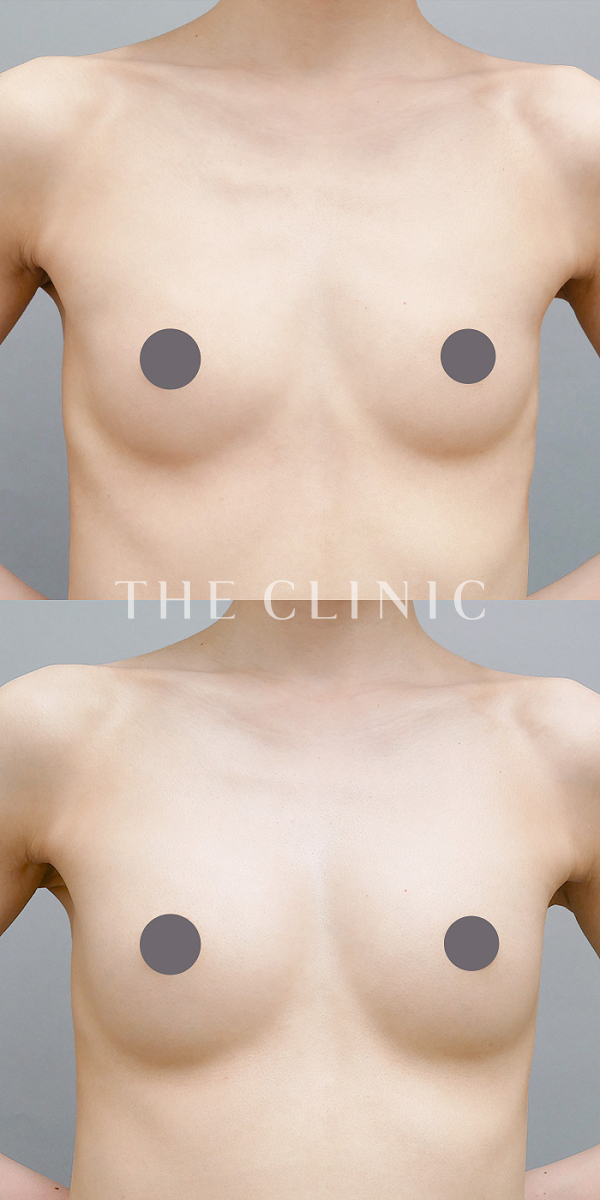 ボリュームアップのコンデンスリッチ豊胸（31歳女性）の術前・術後写真