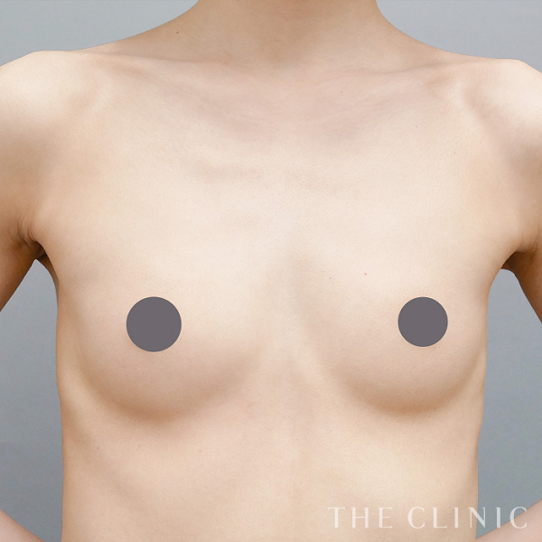 ボリュームアップのコンデンスリッチ豊胸（31歳女性）の術前写真