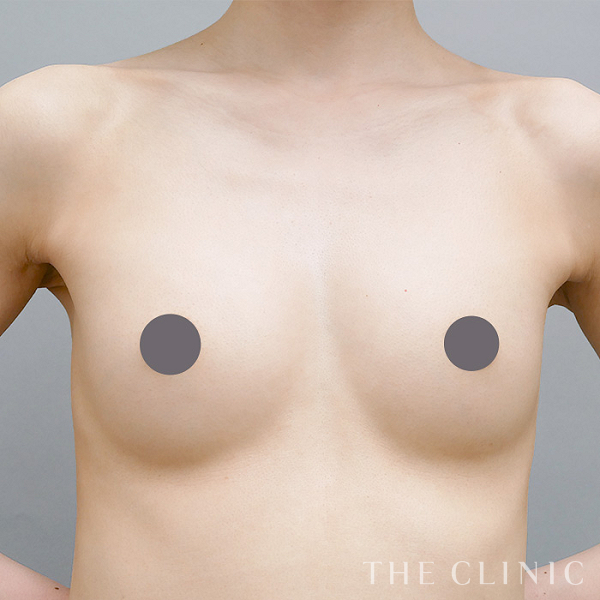 ボリュームアップのコンデンスリッチ豊胸（31歳女性）の術後写真