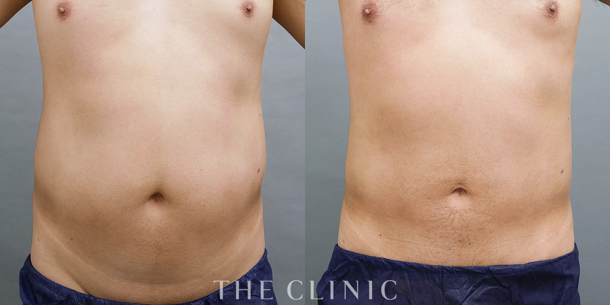 360脂肪吸引®の術前／術後