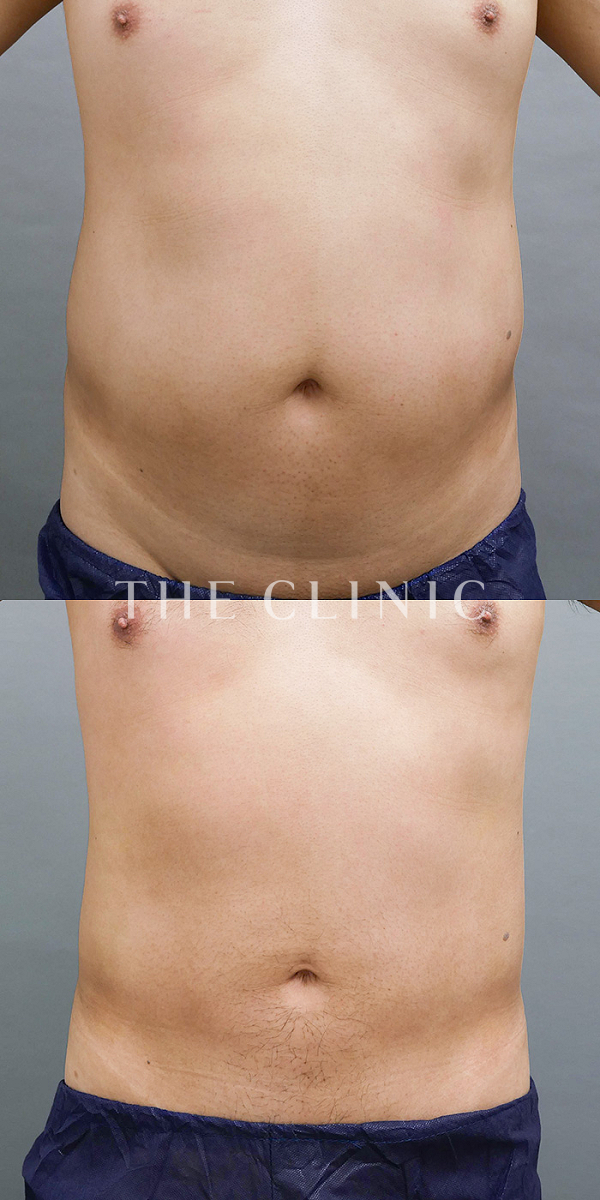 腹部の360脂肪吸引®（39歳男性）の術前・術後写真
