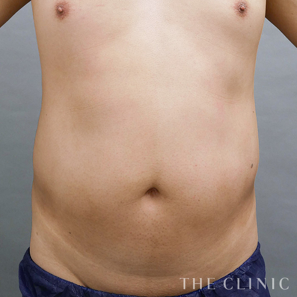 腹部の360脂肪吸引®（39歳男性）の術前写真