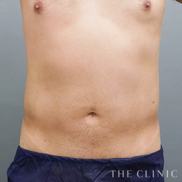 腹部の360脂肪吸引®（39歳男性）の術後写真