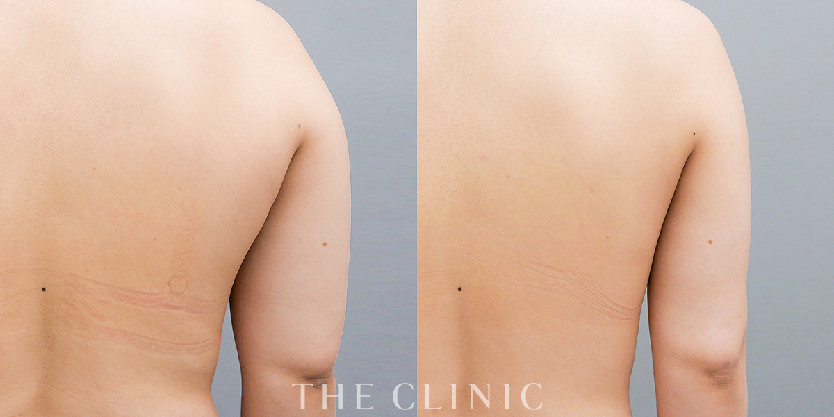 360脂肪吸引®の術前／術後