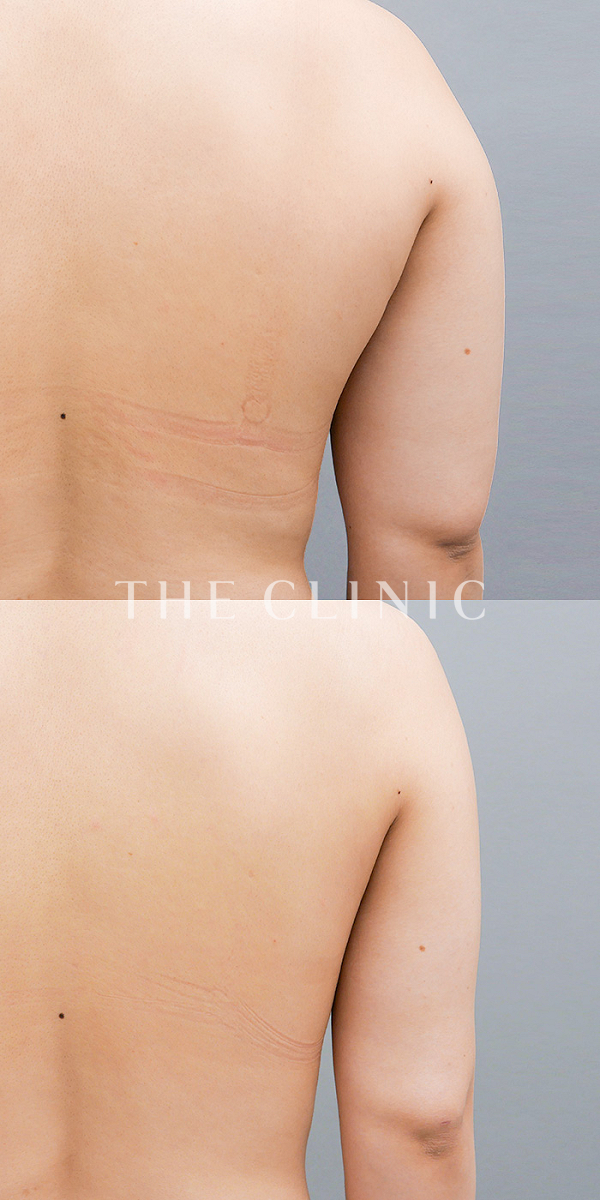 二の腕の360脂肪吸引®（26歳女性）の術前・術後写真