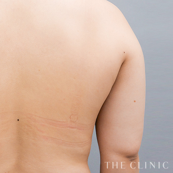 二の腕の360脂肪吸引®（26歳女性）の術前写真