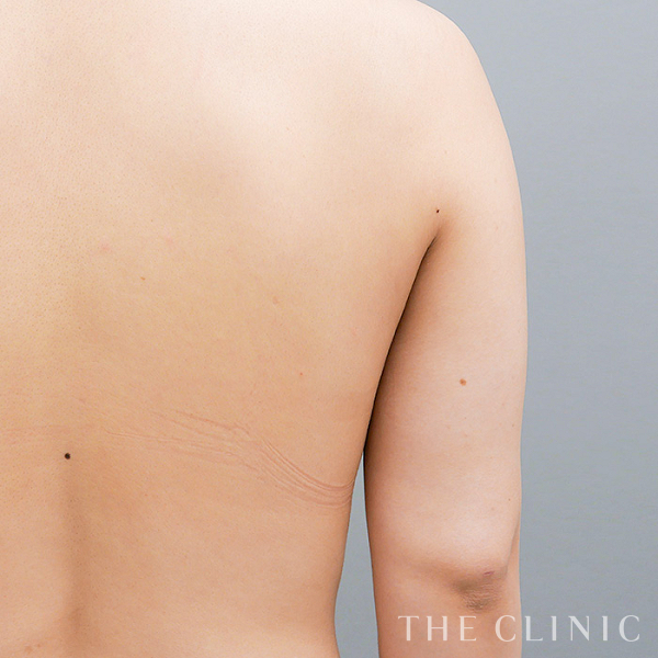 二の腕の360脂肪吸引®（26歳女性）の術後写真