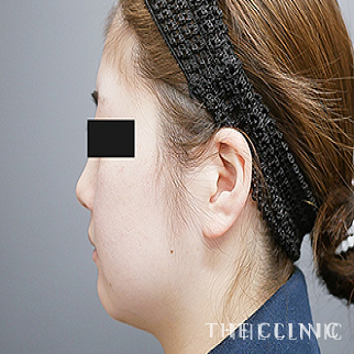 頰／顎の360脂肪吸引®のモニター（20代）術前症例画像