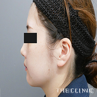 頰/顎の360脂肪吸引®のモニター(20代)術後症例画像