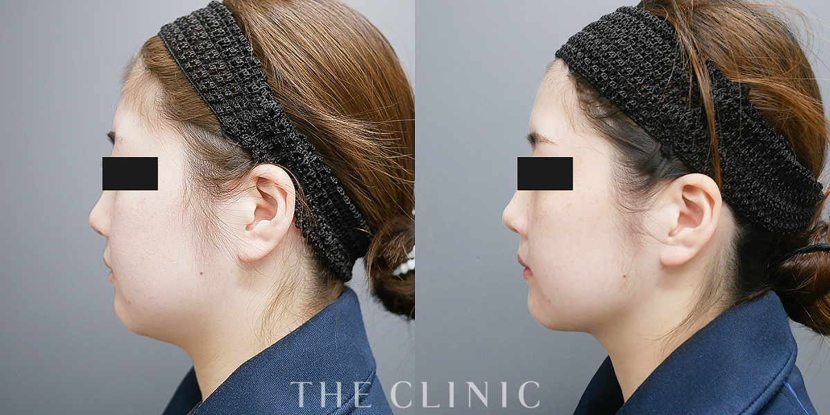 頰／顎の360脂肪吸引®（27歳女性）の術前／術後