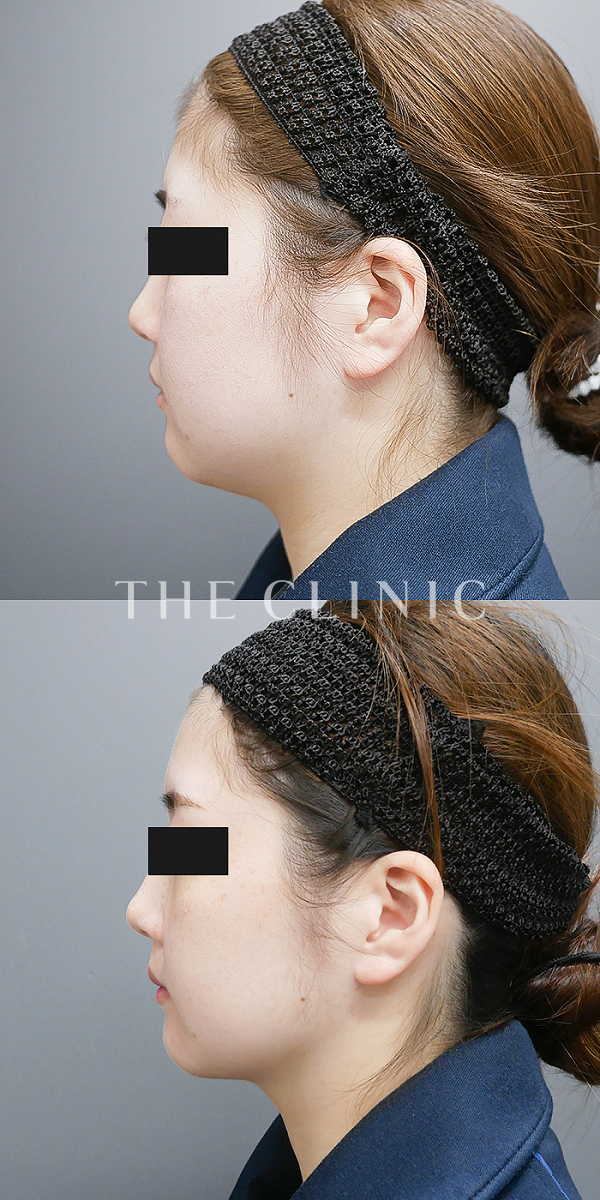 頰／顎の360脂肪吸引®（27歳女性）の術前・術後写真