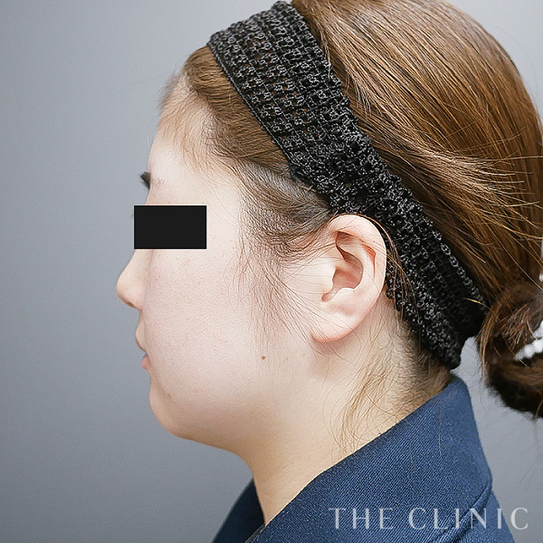 頰／顎の360脂肪吸引®（27歳女性）の術前写真