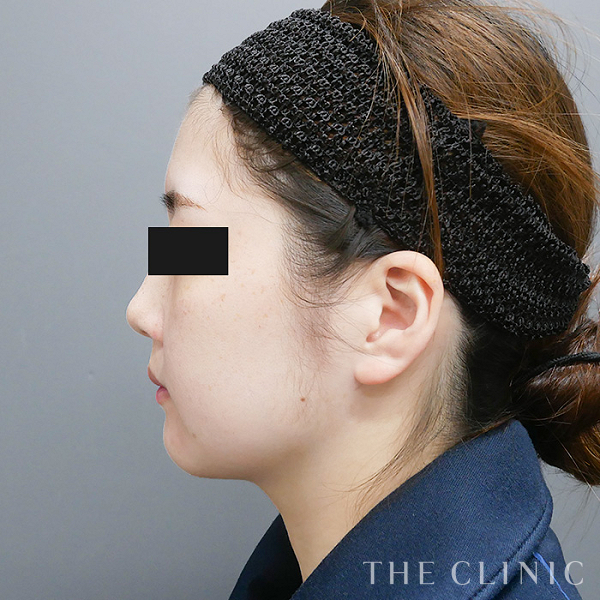 頰／顎の360脂肪吸引®（27歳女性）の術後写真