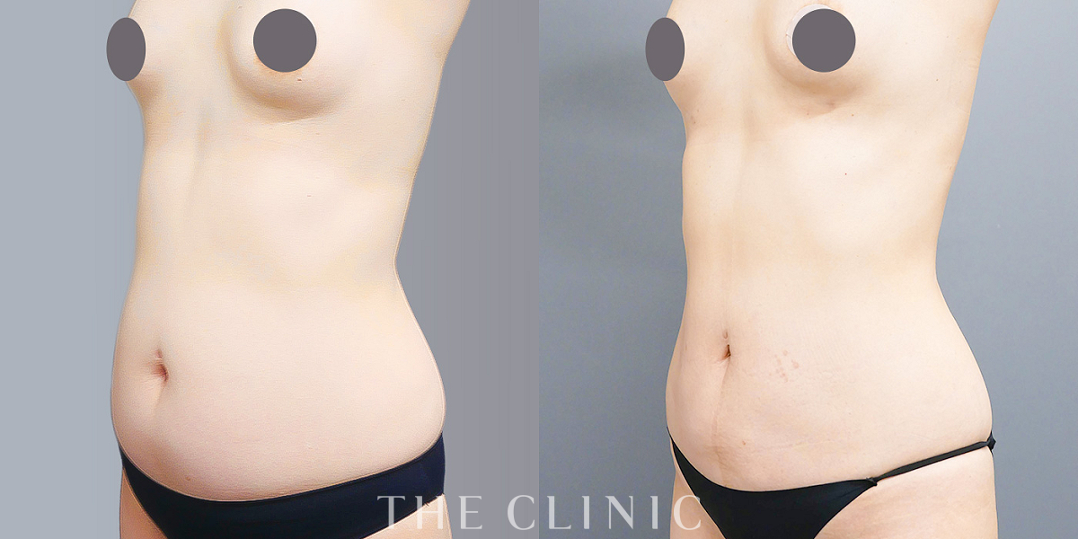 360脂肪吸引®の術前／術後