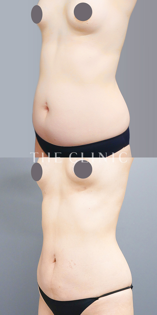 腰・ウエストの360脂肪吸引®（50歳女性）の術前・術後写真