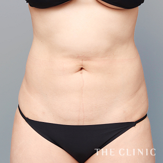 【THE CLINIC 症例画像】No.1616_1_腹部_他院の脂肪吸引修正(執刀医：今西 理也)