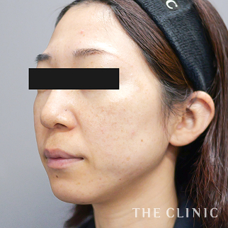 マリオネットラインのコンデンスリッチフェイス(顔の脂肪注入)のモニター（30代）術前症例画像