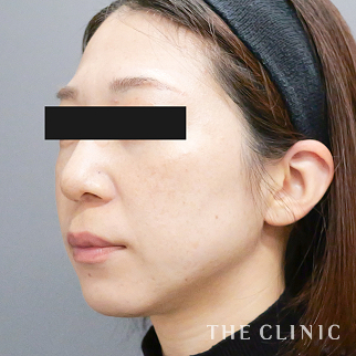 マリオネットラインのコンデンスリッチフェイス(顔の脂肪注入)のモニター（30代）術後症例画像