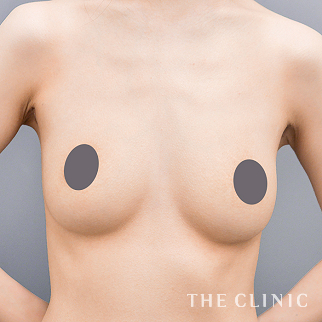 不自然な形の豊胸シリコンバッグ除去のモニター（20代）術後症例画像