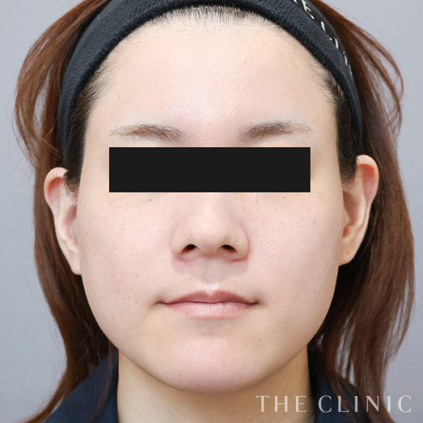 頰／顎の360脂肪吸引®（31歳女性）の術前写真