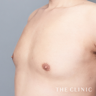【THE CLINIC 症例画像】No.1629_2_偽性女性化乳房_女性化乳房治療(男性の胸の膨らみ改善)(執刀医:)