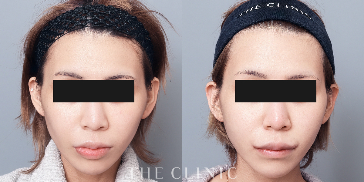 こけた頬のコンデンスリッチフェイス(顔の脂肪注入)（26歳女性）の術前／術後