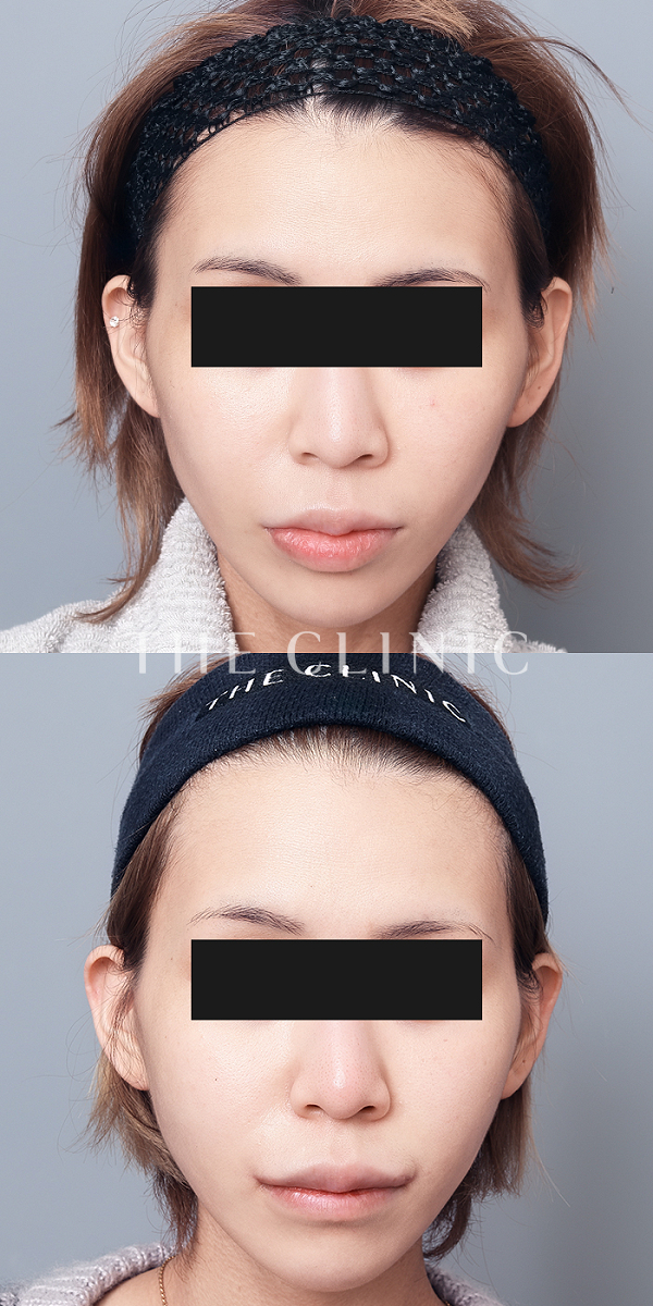 こけた頬のコンデンスリッチフェイス(顔の脂肪注入)（26歳女性）の術前・術後写真