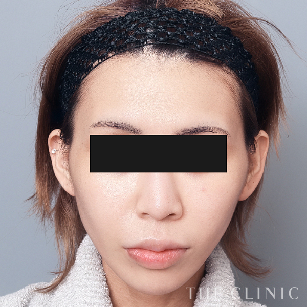 こけた頬のコンデンスリッチフェイス(顔の脂肪注入)（26歳女性）の術前写真