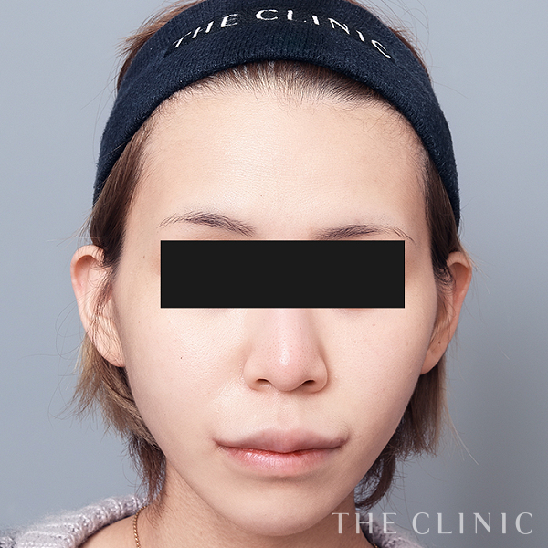 こけた頬のコンデンスリッチフェイス(顔の脂肪注入)（26歳女性）の術後写真