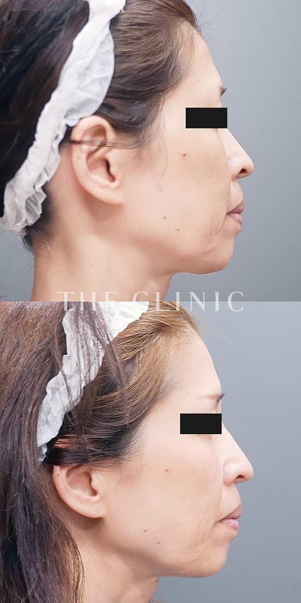 こけた頬のマイクロCRF注入(顔の脂肪注入)（55歳女性）の術前・術後写真