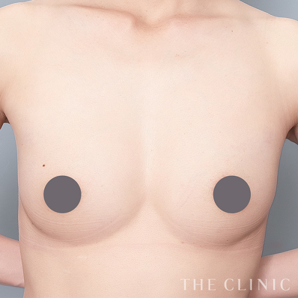 ボリュームアップのナチュラルバスト豊胸（44歳女性）の術後写真