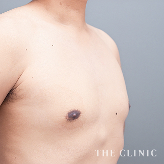 【THE CLINIC 症例画像】No.1640_2_真性女性化乳房_女性化乳房治療(男性の胸の膨らみ改善)(執刀医：安部 光洋)