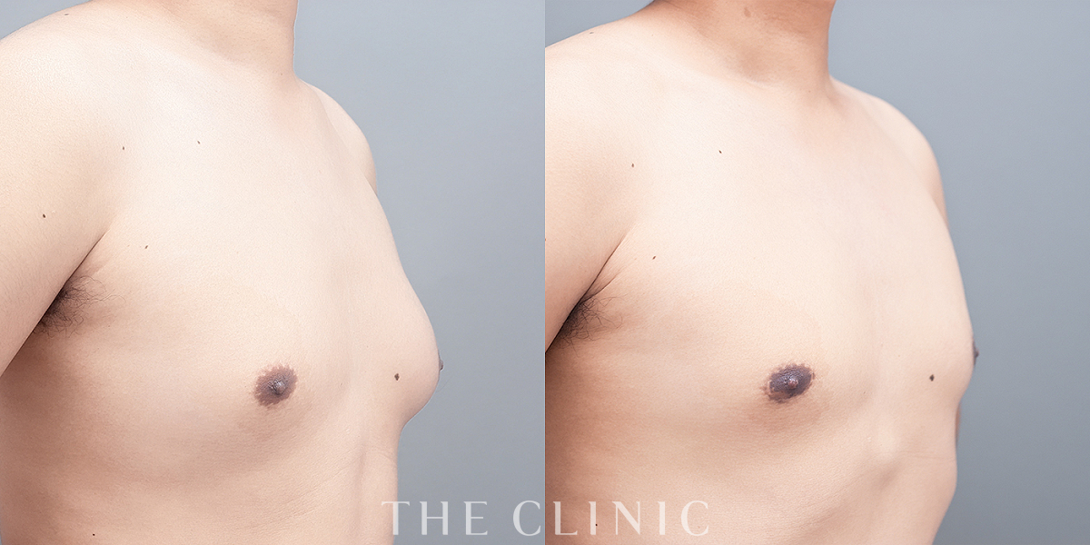女性化乳房治療(男性の胸の膨らみ改善)の術前／術後