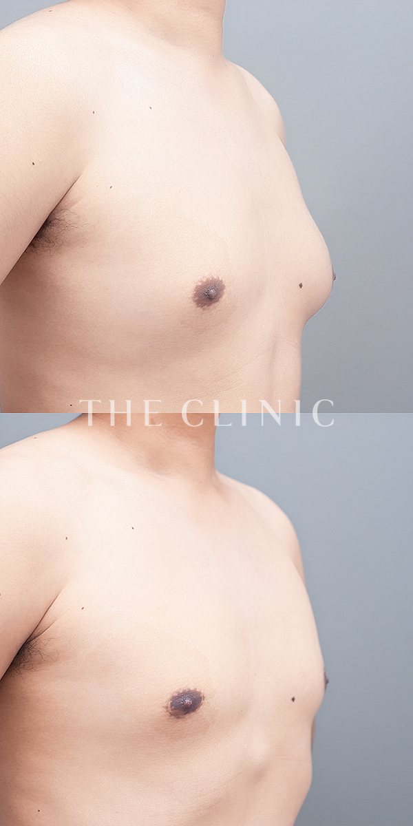 真性女性化乳房の女性化乳房治療(男性の胸の膨らみ改善)（29歳男性）の術前・術後写真