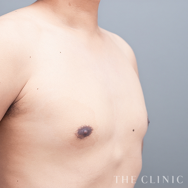 真性女性化乳房の女性化乳房治療(男性の胸の膨らみ改善)（29歳男性）の術後写真
