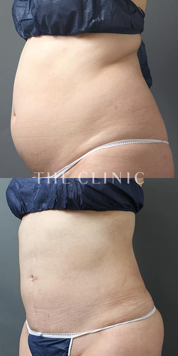 腹部のベイザー脂肪吸引（32歳女性）の術前・術後写真