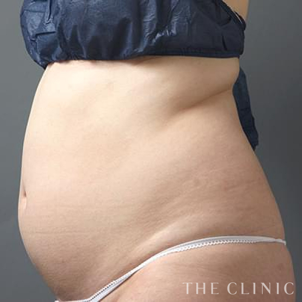 腹部のベイザー脂肪吸引（32歳女性）の術前写真