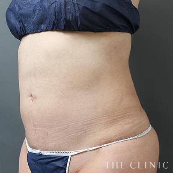 腹部のベイザー脂肪吸引（32歳女性）の術後写真