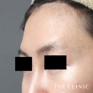 おでこ(額)のくぼみのコンデンスリッチフェイス(顔の脂肪注入)のモニター（30代）術前症例画像