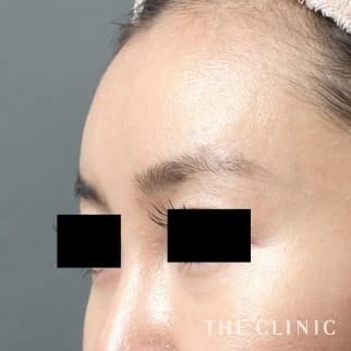 おでこ(額)のくぼみのコンデンスリッチフェイス(顔の脂肪注入)のモニター(30代)術後症例画像