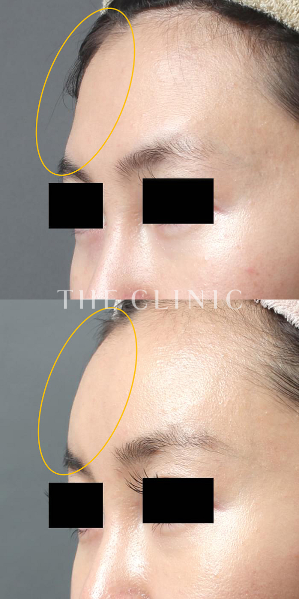 おでこ(額)のくぼみのコンデンスリッチフェイス(顔の脂肪注入)（31歳女性）の術前・術後写真