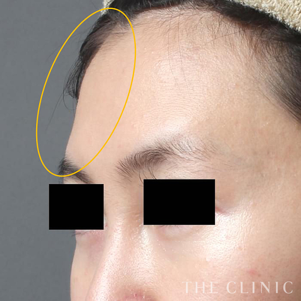 おでこ(額)のくぼみのコンデンスリッチフェイス(顔の脂肪注入)（31歳女性）の術前写真