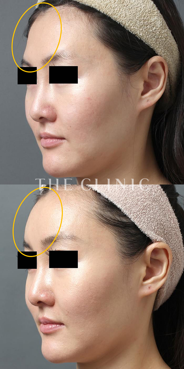 こけた頬のコンデンスリッチフェイス(顔の脂肪注入)（31歳女性）の術前・術後写真