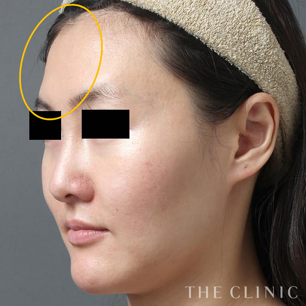 こけた頬のコンデンスリッチフェイス(顔の脂肪注入)（31歳女性）の術前写真