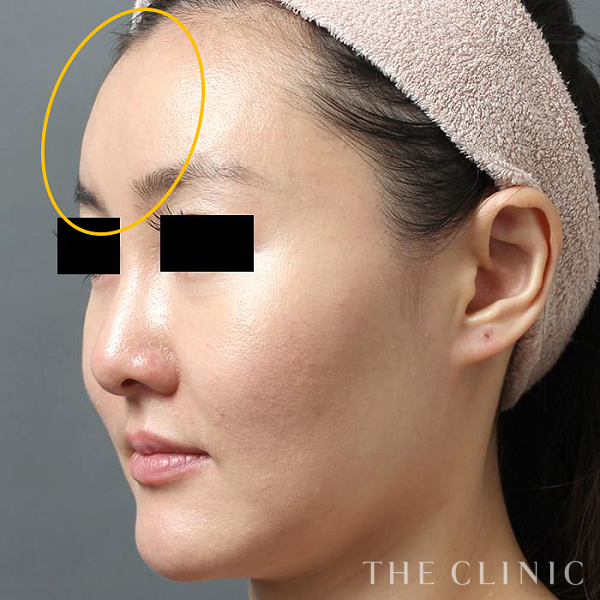 こけた頬のコンデンスリッチフェイス(顔の脂肪注入)（31歳女性）の術後写真